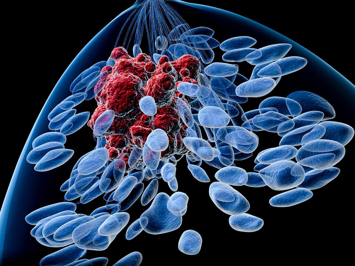Lancet: препараты для профилактики рака груди нужны при высоком эстрогене