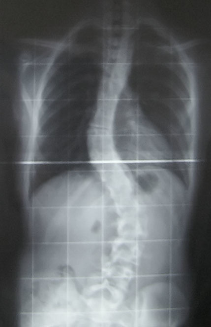 Ученые из Перми создали систему на основе ИИ для диагностики сколиоза по фотографиям спины