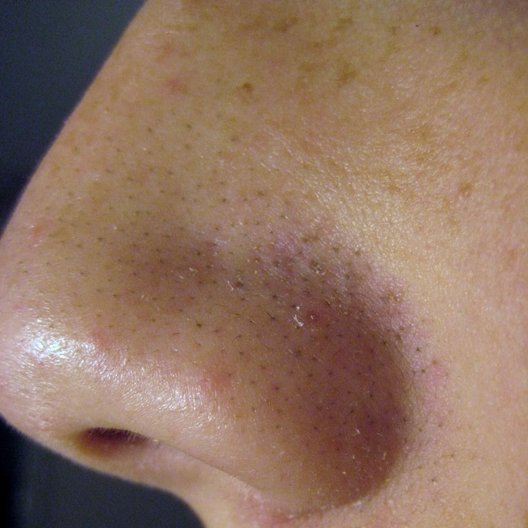 Исследование ученых из США выявило, что акне может оказаться полезным для здоровья кожи лица