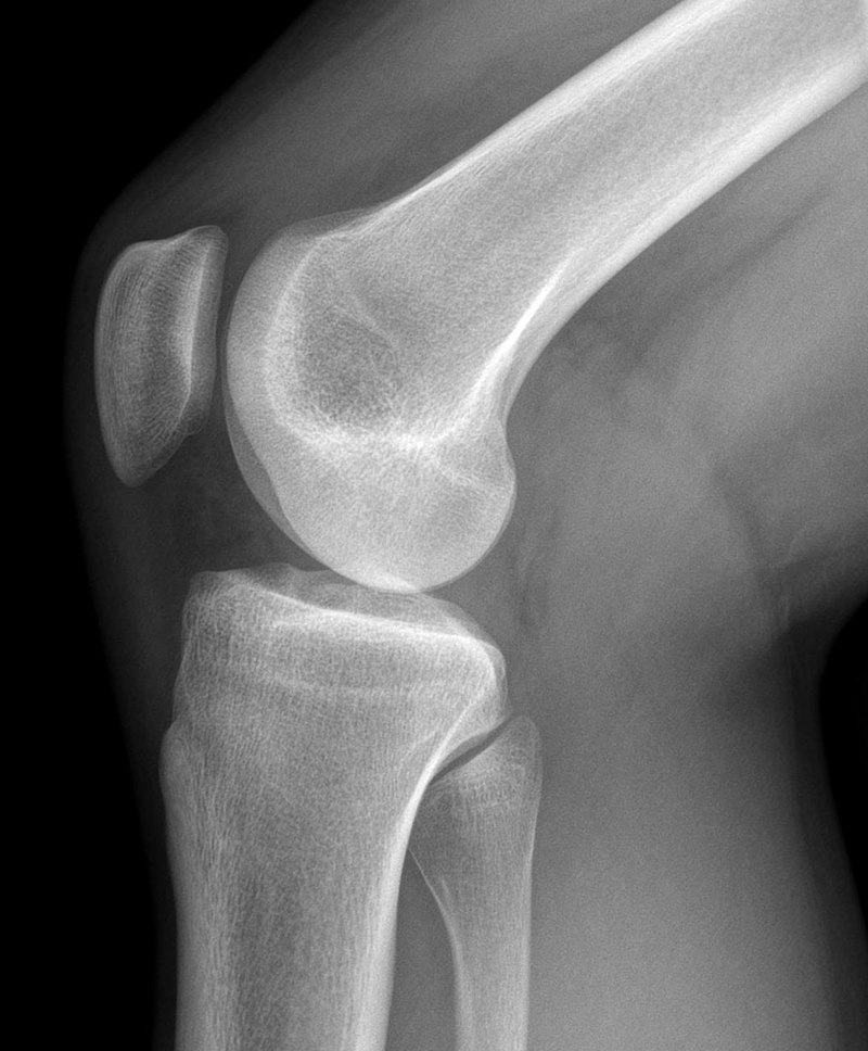 Открыт метод уменьшения вероятности развития остеоартрита в коленных и тазобедренных суставах