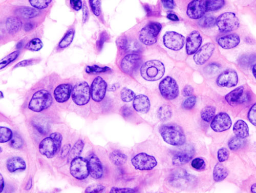 Исследования показали, что развитие метастазов рака кишечника связано с формой белка CD44