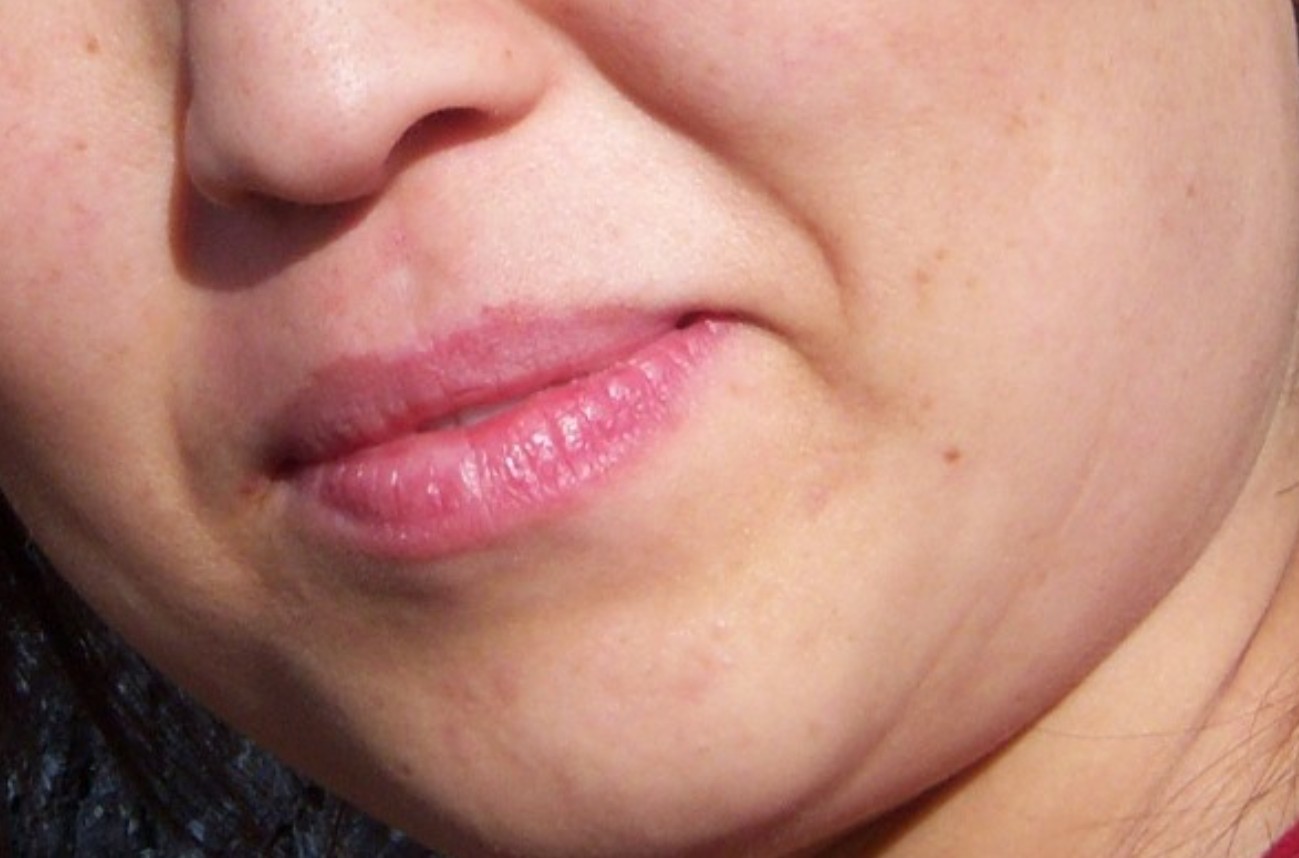 Дерматолог Константинова сообщила, что сухость губ может указывать на проблемы с ЖКТ и анемию