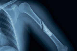 Минздрав напоминает: регулярная диагностика костей помогает избежать переломов при остеопорозе