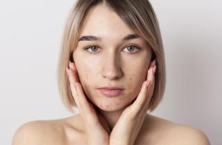 Гормональные колебания остаются основной причиной акне у взрослых женщин, отмечают дерматологи