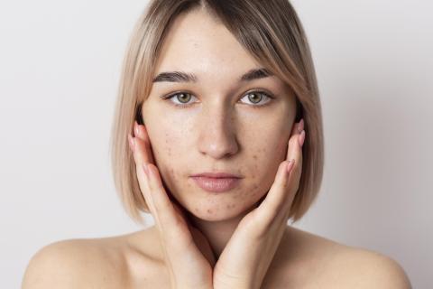 Гормональные колебания остаются основной причиной акне у взрослых женщин, отмечают дерматологи