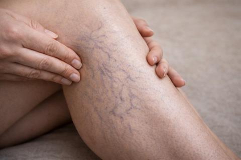 Спортзал превращает вены в зону риска: привычная штанга запускает скрытый механизм варикоза