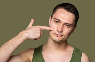 Акне, вызванное тестостероном, может сохраняться до нормализации уровня гормонов