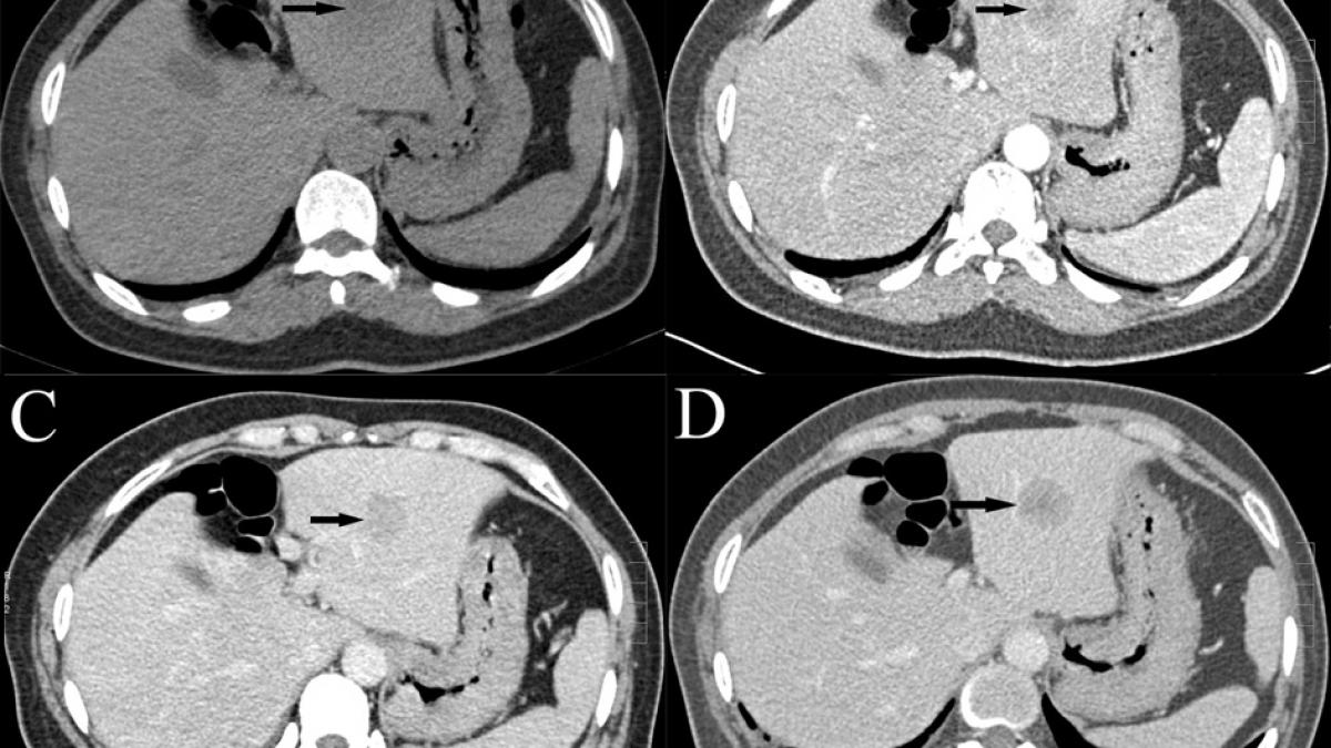 Triphasic CT scan of hepatocellular carcinoma Triphasic CT scan of hepatocellular carcinoma