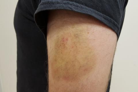 Синяки без травм возникают при хрупкости сосудов, объясняет врач Людмила Лапа