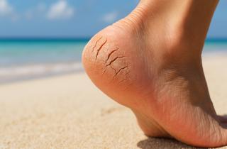 Чрезмерное шлифование кожи стоп вызывает её растрескивание — подолог Волкова