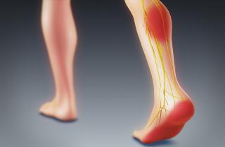 Профилактика тромбоза начинается с движения, воды и контроля веса — Антон Кравцов