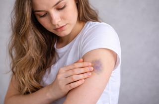 Синяки растут и темнеют сами по себе: организм намекает на проблемы, которые легко пропустить