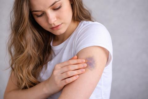 Синяки растут и темнеют сами по себе: организм намекает на проблемы, которые легко пропустить