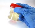 HealthDay: появился эффективный тест определения раннего предрака шейки матки HealthDay: появился эффективный тест определения раннего предрака шейки матки