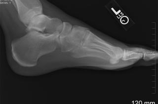 Стрессовые переломы стопы возникают у спортсменов из-за перегрузки при тренировках — врач Лиза Каллахан