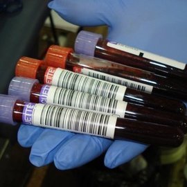 Ученые разработали метод лечения рака крови клетками-киллерами
