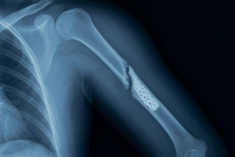 Новый белок GPR133 усилил рост костей у мышей с остеопорозом — Лейпцигский университет