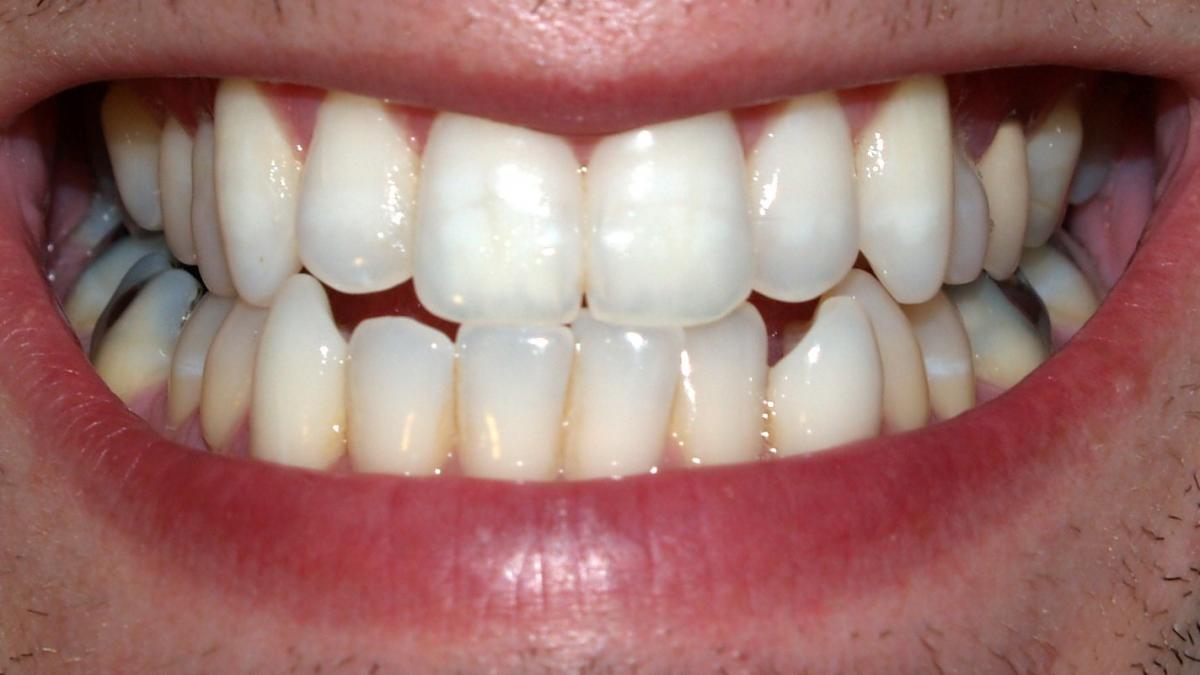 Teeth by David Shankbone Teeth by David Shankbone