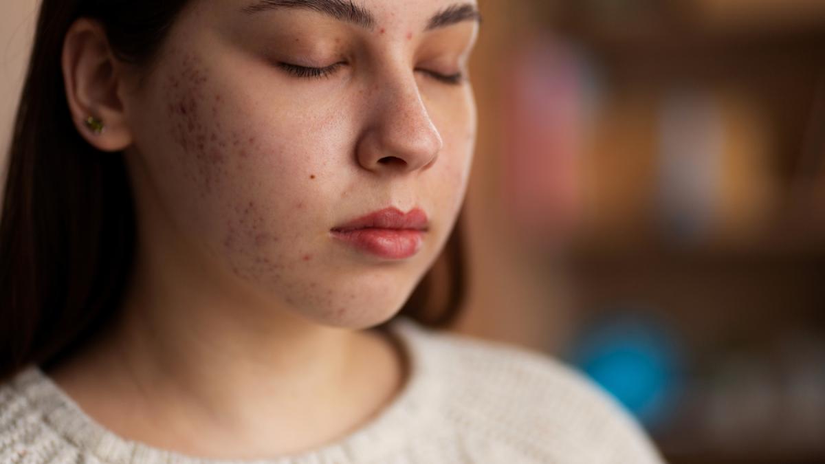 Проблемная кожа с постакне