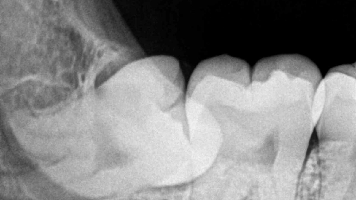 Impacted Wisdom Tooth aka Lower Right Third Molar 48 RVG IOPA Xray Impacted Wisdom Tooth aka Lower Right Third Molar 48 RVG IOPA Xray