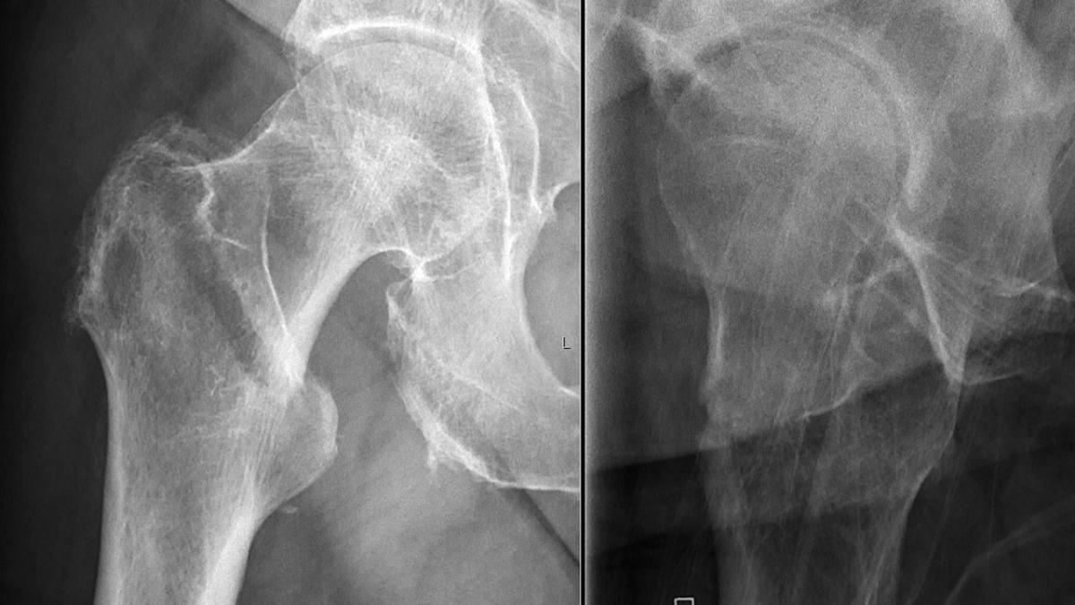 Перелом шейки бедра