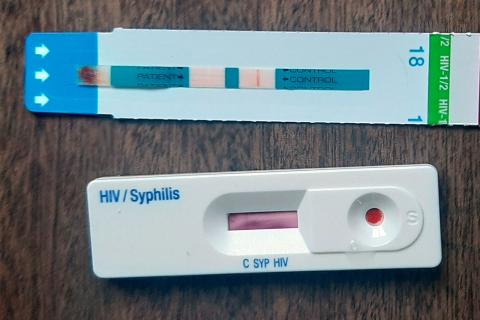 Поздние стадии сифилиса нередко выявляют из-за слабых симптомов — дерматолог Наталья Махнева