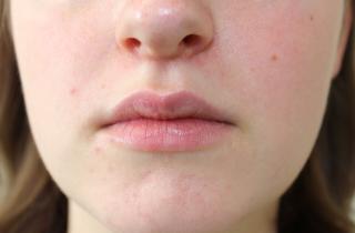 Патч-тест выявляет вещества, вызывающие воспаление кожи — Университет Техаса