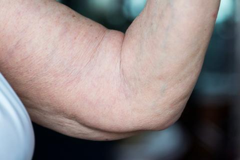 Сосудистые звездочки могут сигнализировать о серьезной проблеме — флеболог Богачев