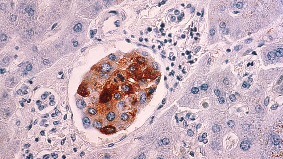 Метастазирование рака молочной железы в печень