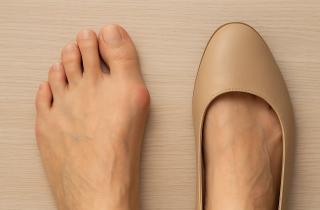 Узкая обувь является главной причиной косточек на ногах — ортопеды