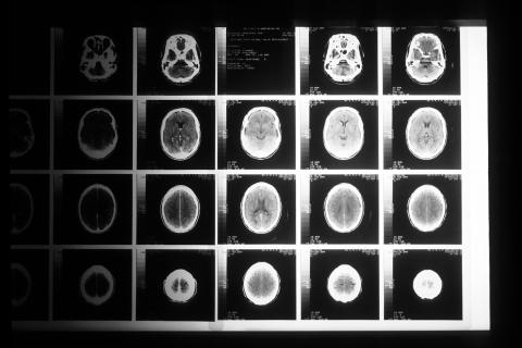 The Lancet: к 2050 году число случаев рака в мире достигнет 30,5 млн
