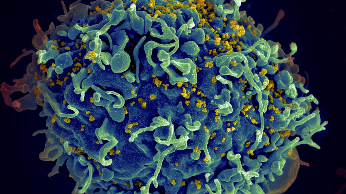 Scanning electron micrograph of a human H9 T cell infected with HIV virus particles